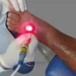 Conhecendo os benefícios da Laserterapia no tratamento de feridas