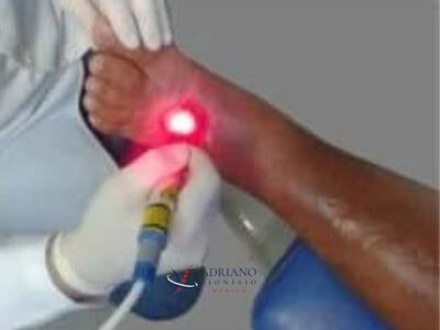 Laser para tratamento de feridas